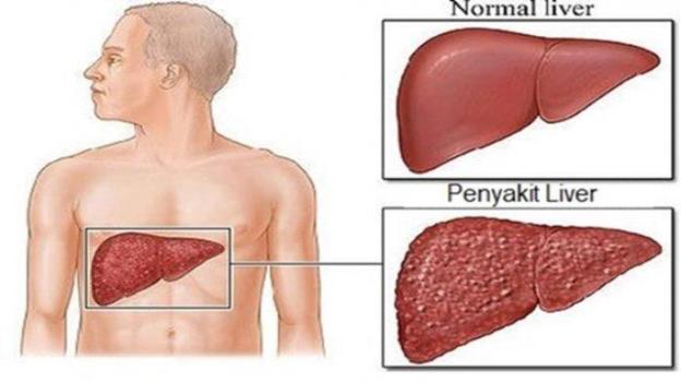 Pengertian Singkat Penyakit Liver